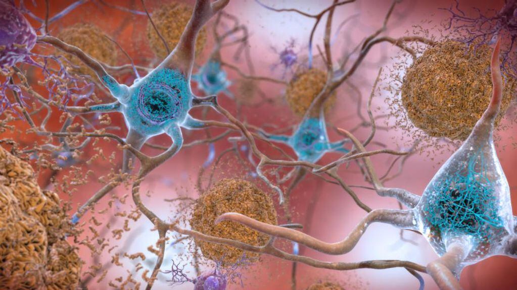 PLACAS. La formación de placas (en marrón) en el cerebro es la característica principal del Alzheimer, pero ningún tratamiento ha podido combatirlas. (NIH)
